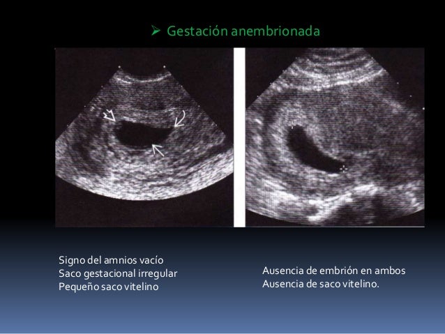 gestacion anembrionada